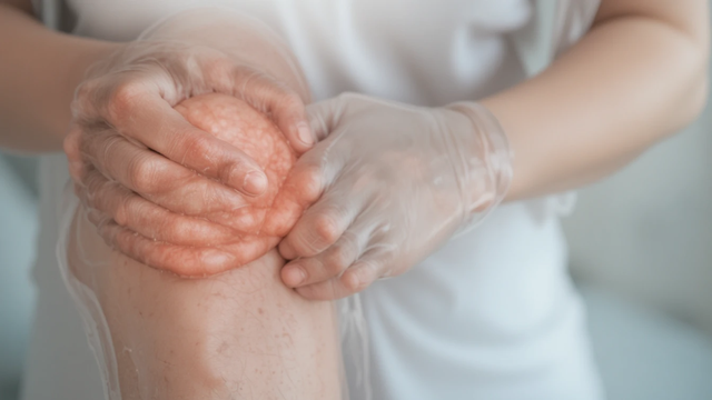 Mitos dan Fakta tentang Artritis